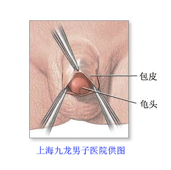 包皮过长有什么影响