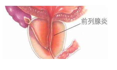 前列腺炎的医治费用一般是多少
