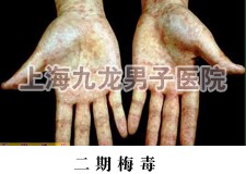 早期梅毒的症状图片(二期)