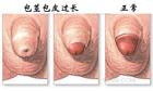 包茎手术图片