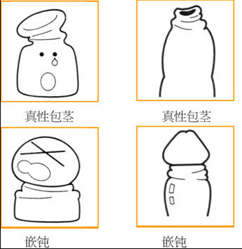 (真性、假性、嵌顿)包茎图片