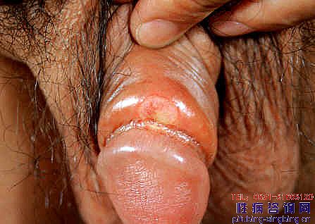 ÷��ͼƬ��÷��֢״��÷�����κ���