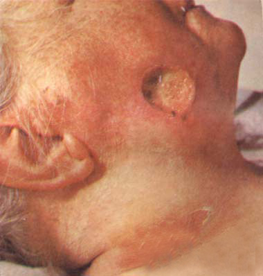 ÷��ͼƬ��÷��֢״��÷�����κ���